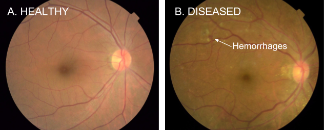 DiabeticEye